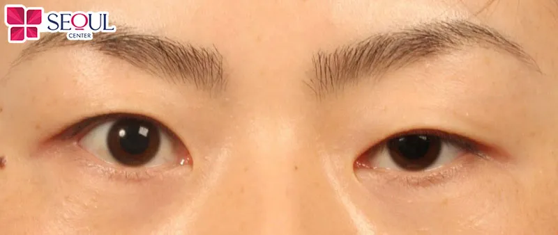 Những người có mí mắt không đều, mí sụp, mắt một mí rất phù hợp cắt mí