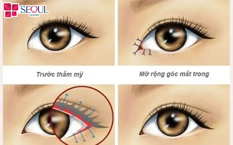 Kỹ thuật cắt mí phượng hoàng rất phức tạp, cần bác sĩ chuyên môn cao thực hiện