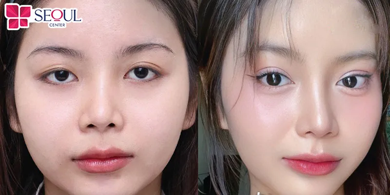 Cắt mí phượng hoàng sở hữu nhiều ưu điểm vượt trội