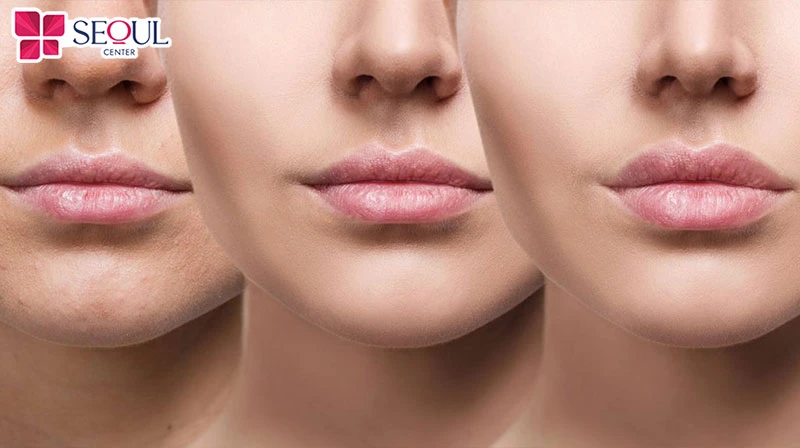 Seoul Center - Đơn vị cung cấp dịch vụ cấy môi sinh học đẹp, uy tín