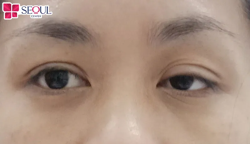 Mí mắt sụp, thiếu cân đối nên thực hiện chỉnh nhược cơ mí mắt