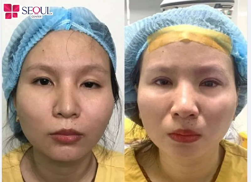 Chỉnh nhược cơ mí mắt mang lại kết quả thẩm mỹ bền vững, tự nhiên, đặc biệt giúp giảm hình thành nếp nhăn vùng trán khá tốt