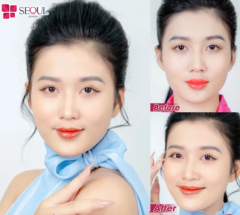 Khách hàng sau khi chỉnh cơ mí mắt tại Seoul Center