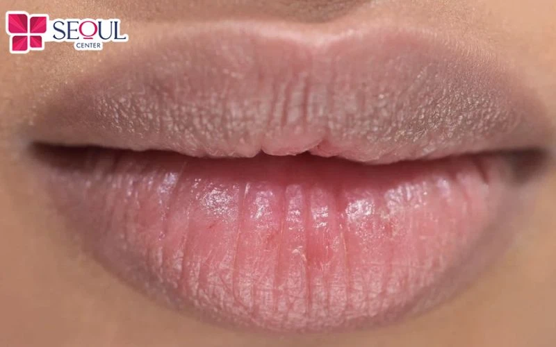 Những người bị môi thâm xỉn màu, khô ráp, bong tróc rất phù hợp với phun môi collagen
