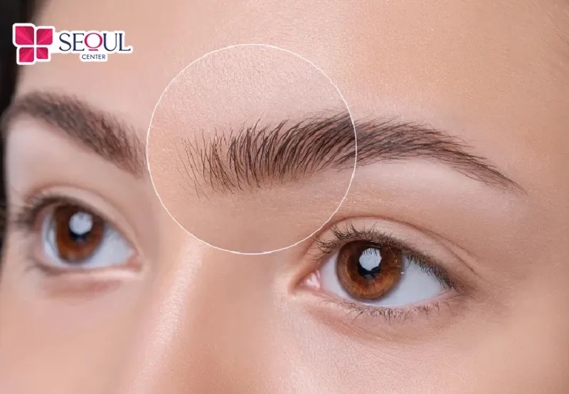 Cấy lông mày là giải pháp khắc phục tình trạng lông mày rụng quá nhiều nhưng khó mọc lại khá hữu hiệu