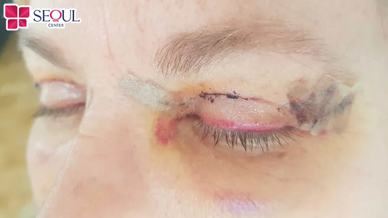 Tình trạng mí mắt cần áp dụng dịch vụ sửa mí mắt