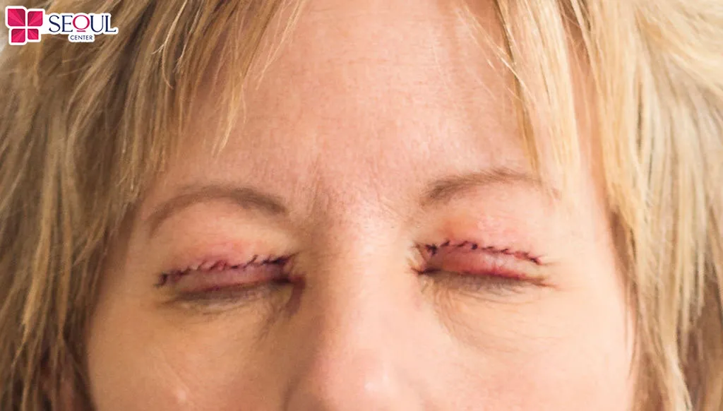 Sửa mí giúp tạo nếp mí tự nhiên, hài hòa gương mặt