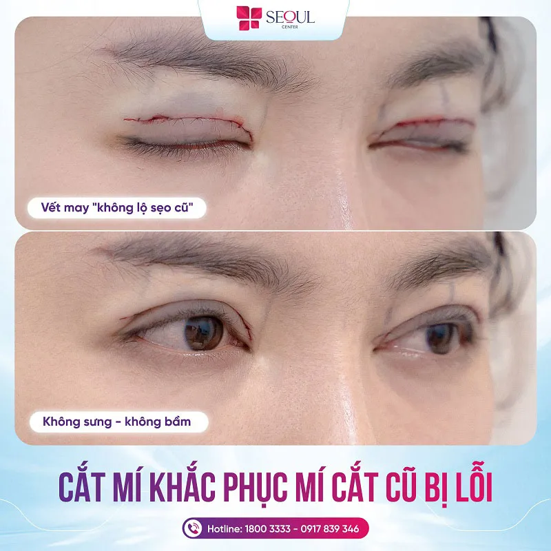 Khách hàng sau khi thực hiện quy trình sửa mí chuẩn y khoa, các lỗi mí cũ đã được khắc phục hoàn toàn