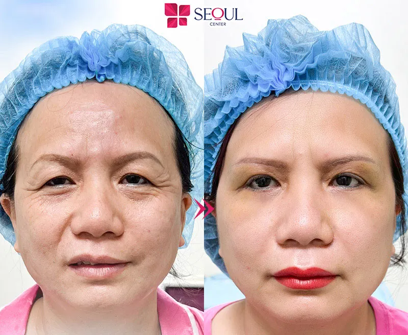 Các dấu hiệu lão hóa được cải thiện toàn diện nhờ Midface căng da mí dưới tại Seoul Center