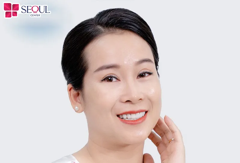 Phương pháp Midface căng da mí dưới sở hữu nhiều ưu điểm trẻ hóa vượt trội