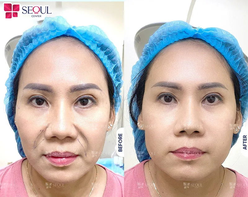 Midface căng da mí dưới tại Seoul Center giúp trẻ hóa da mặt hiệu quả