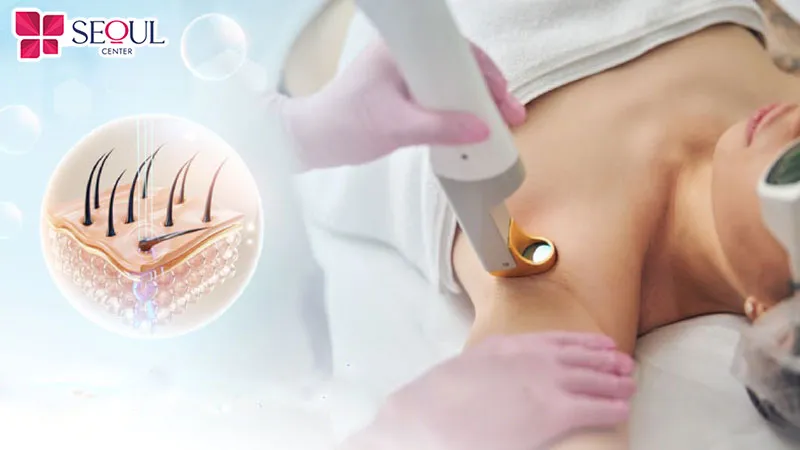 Công nghệ triệt lông cũng là một trong những yếu tố ảnh hưởng đến khoảng cách mỗi lần triệt