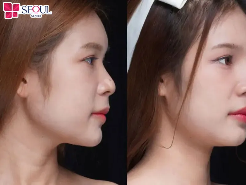 Nâng mũi bán cấu trúc Nano Hàn sử dụng dòng sụn Nano nhập khẩu từ Hàn Quốc để cải thiện dáng mũi