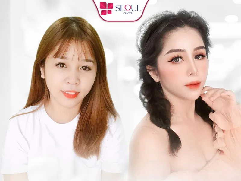 Thẩm mỹ viện Seoul Center cung cấp dịch vụ nâng mũi bán cấu trúc chất lượng, uy tín, chi phí phải chăng