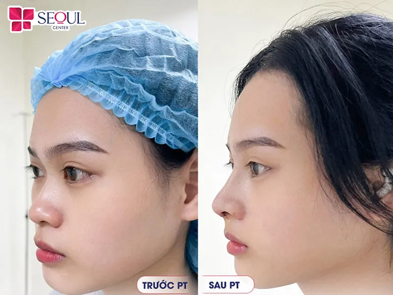 Thẩm mỹ viện Seoul Center là địa chỉ nâng mũi chất lượng, được đông đảo khách hàng tin cậy