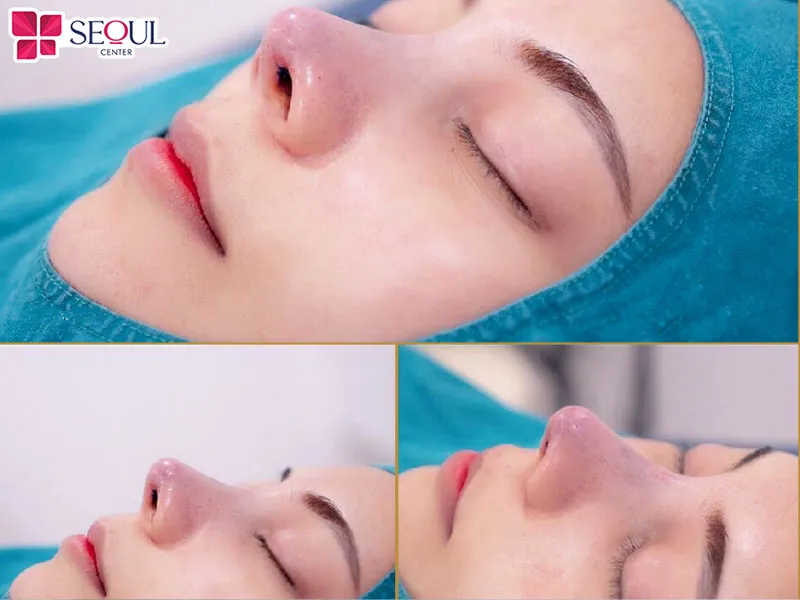 Nâng mũi Surgiform bán cấu trúc giúp dáng mũi đẹp tự nhiên, hạn chế tối đa xâm lấn