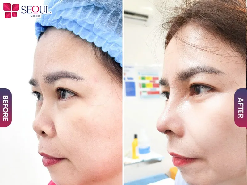 Thẩm mỹ viện Seoul Center cung cấp dịch vụ nâng mũi bán cấu trúc Surgiform cao cấp, chất lượng