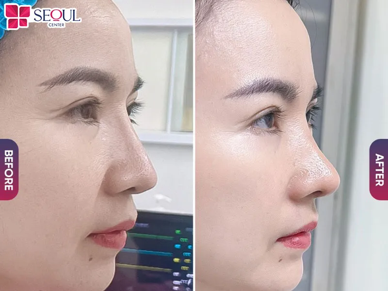 Quy trình nâng mũi bán cấu trúc tự thân Nano Hàn cần phải tuân thủ quy trình theo quy định