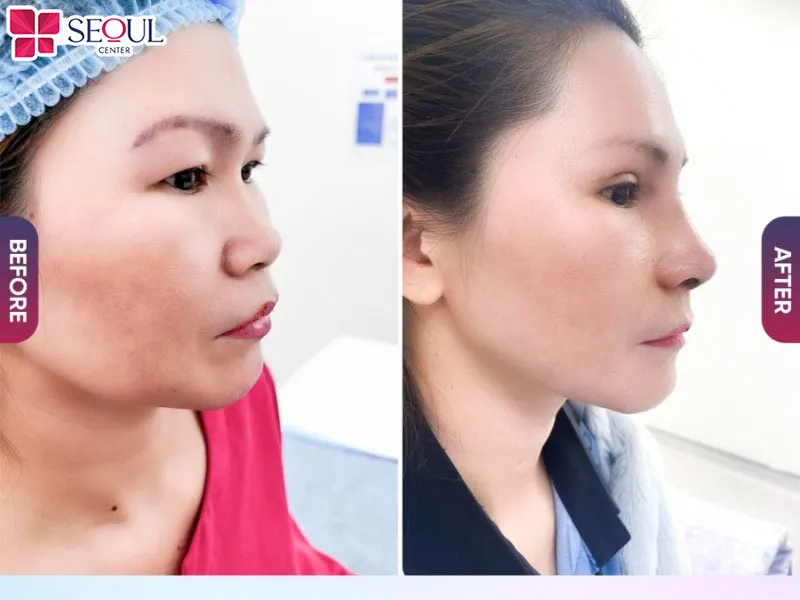 Nâng mũi bán cấu trúc tự thân Nano Mỹ thực hiện đúng quy trình