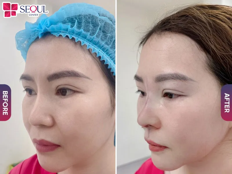 Bác sĩ tiến hành phác thảo sụn mũi theo đúng tỷ lệ trước khi nâng mũi