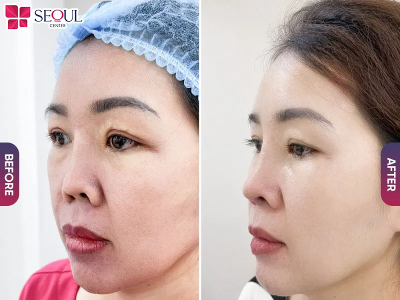 Dáng mũi trước và sau khi nâng có sự thay đổi rõ rệt