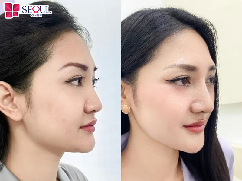 Mỗi phương pháp nâng mũi sẽ có mức chi phí khác nhau