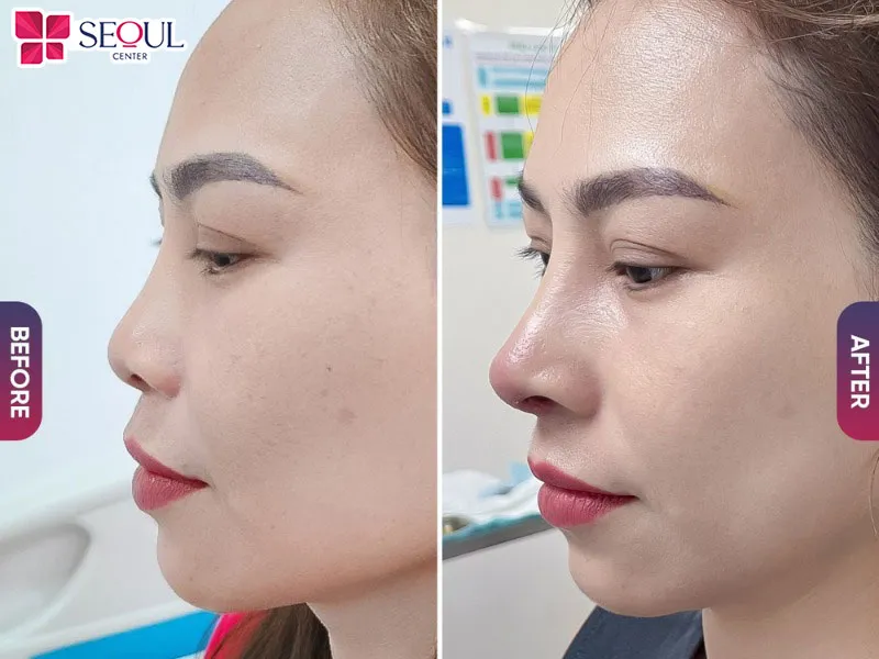 Nâng mũi cấu trúc tự thân Nano Hàn giúp dáng mũi cao ráo, tự nhiên, hài hòa với gương mặt