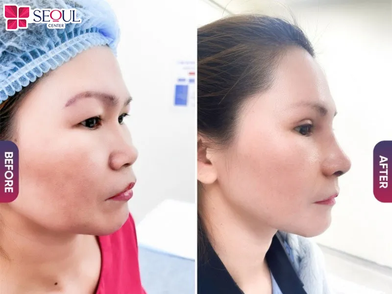 Thẩm mỹ viện Seoul Center tự hào là địa chỉ cung cấp dịch vụ nâng mũi cấu trúc tự thân Nano Hàn uy tín
