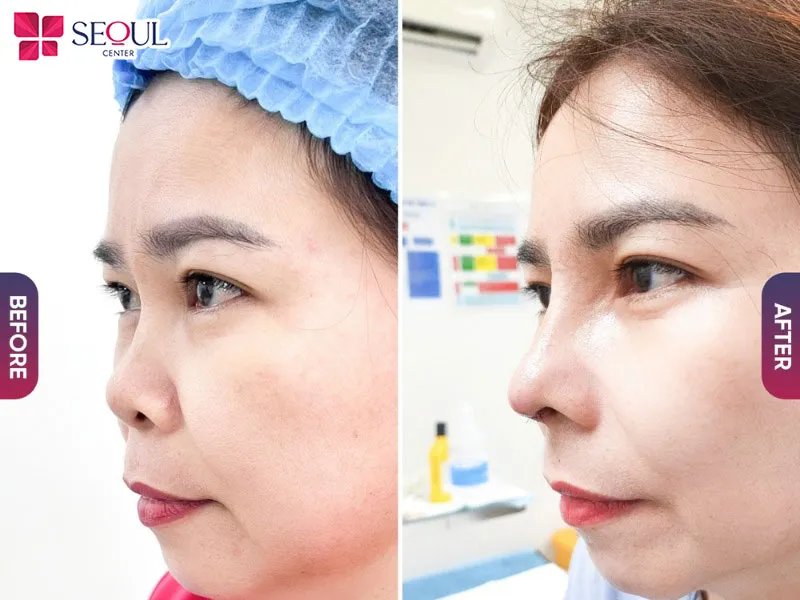 Quy trình nâng mũi cấu trúc chuẩn y khoa giúp dáng mũi cao, cải thiện mọi nhược điểm đang gặp