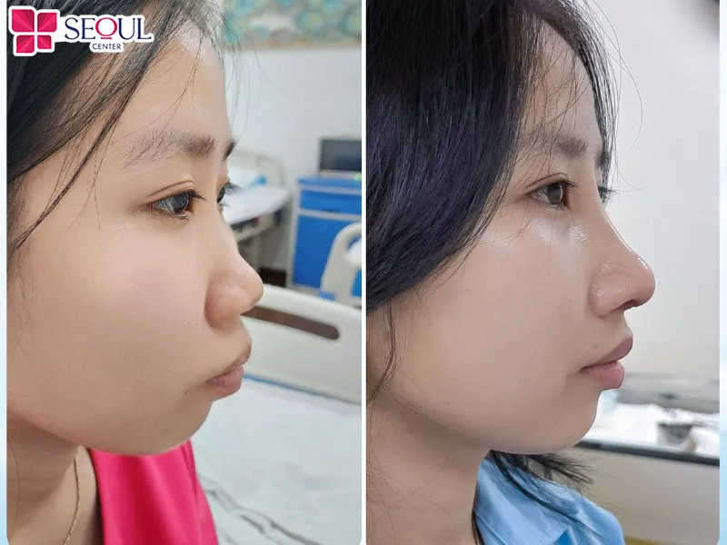 Quy trình nâng mũi cấu trúc tự thân Surgiform được thực hiện theo đúng quy định