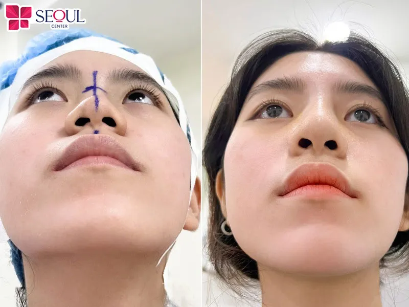 Quy trình nâng mũi tự thân sử dụng sụn sườn cần đảm bảo thực hiện theo đúng quy định