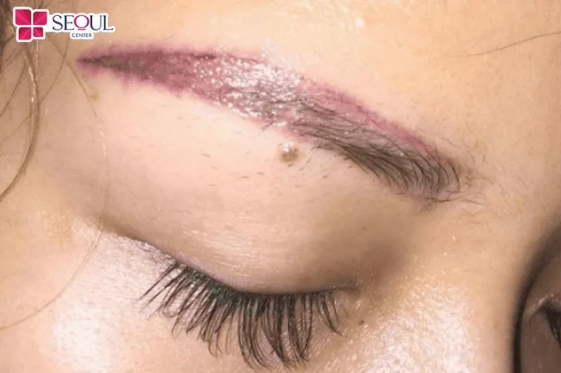 Bị nổi mụn nước sau phun mày là dấu hiệu cho thấy da đang bị nhiễm trùng