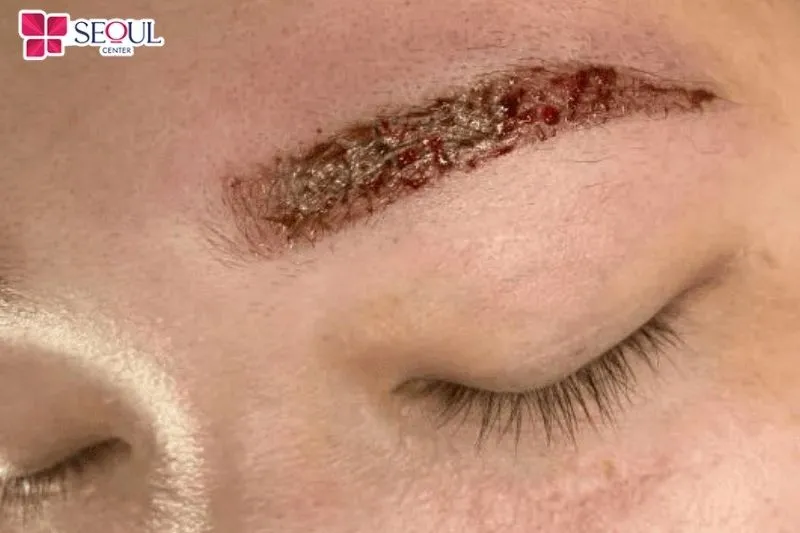 Không chăm sóc chân mày đúng cách sau khi phun sẽ làm tăng nguy cơ viêm nhiễm