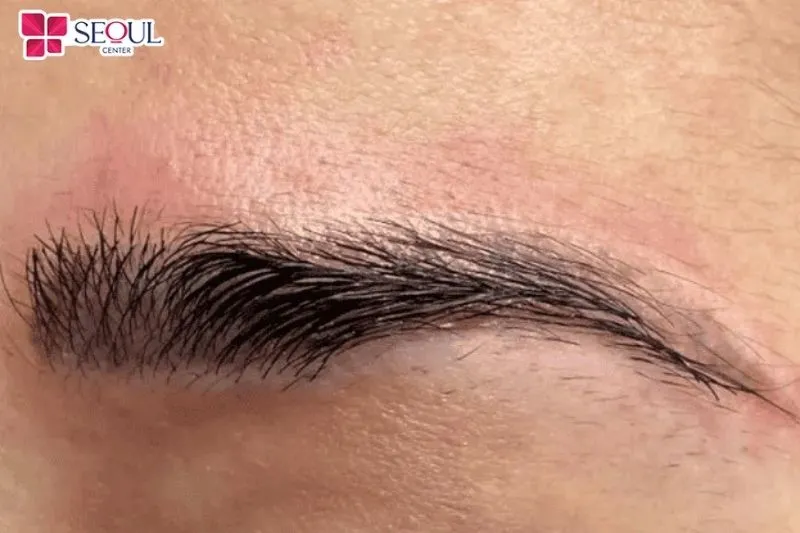 Người có cơ địa nhạy cảm sẽ dễ xuất hiện mụn nước sau khi phun mày