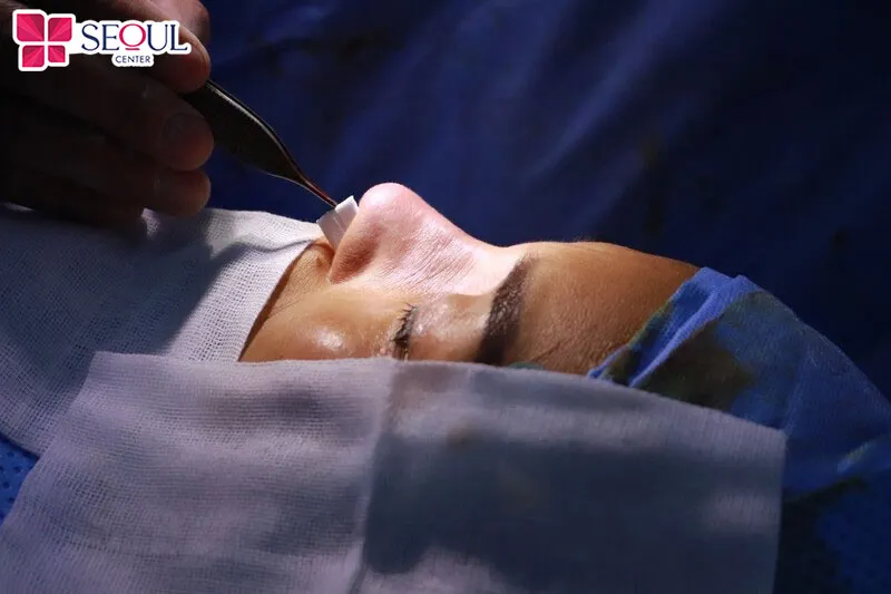 Tháo rút chất liệu mũi sau một thời gian nâng mũi bị hỏng