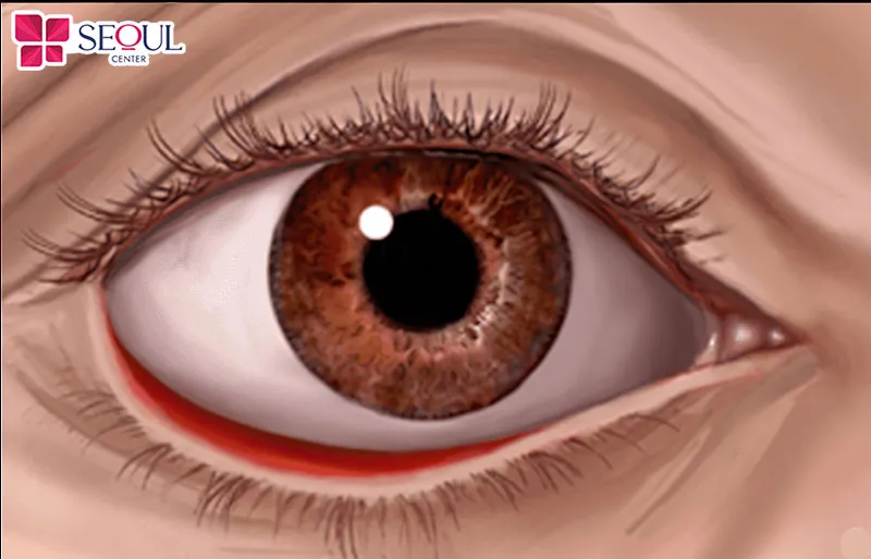 Lật mí dưới là hiện tượng mí dưới không áp sát với nhãn cầu