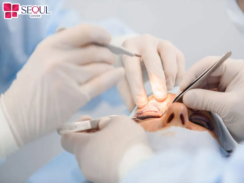 Phẫu thuật điều trị lật mi dưới để nâng cao tính thẩm mỹ và cải thiện sức khỏe thị giác