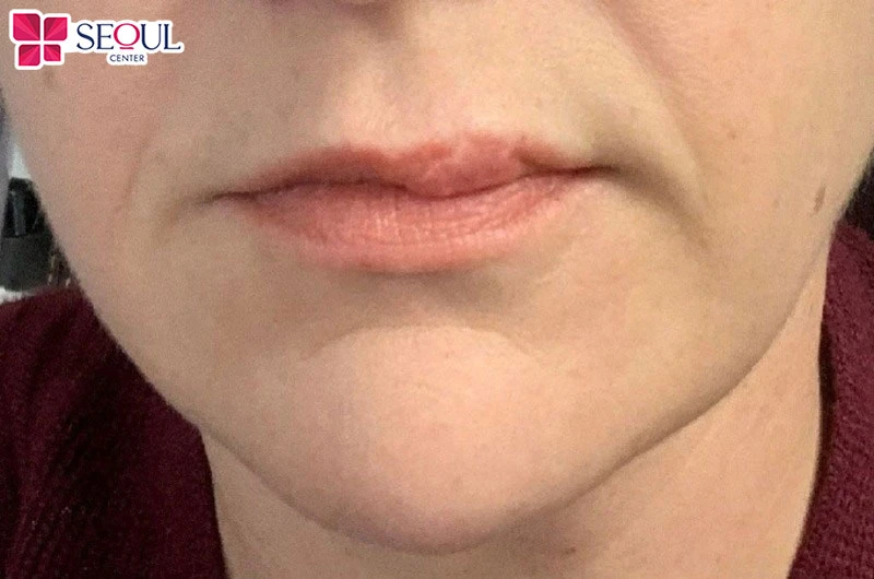 Phun môi collagen đi kim quá sâu dễ để lại sẹo lồi