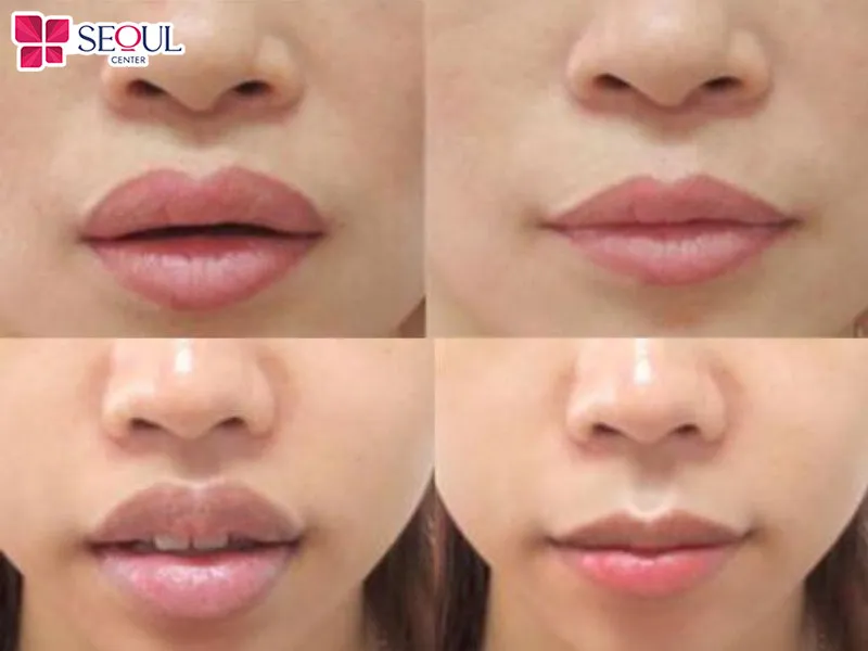 Tạo hình môi Perfect phù hợp với người có môi thô kệch, thiếu cân đối với tỷ lệ gương mặt