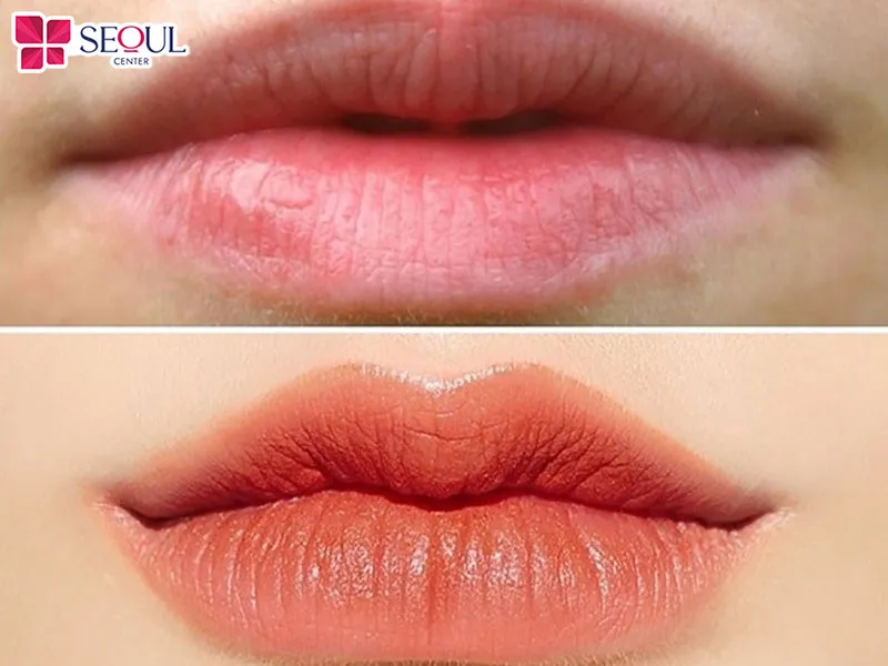 Chi phí tạo hình môi Perfect hiện nay là 18.000.000 VNĐ