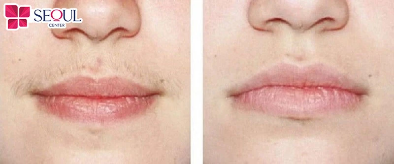 Triệt ria mép bằng kem đánh răng có thể loại bỏ lông tạm thời, tiết kiệm chi phí, dễ thực hiện