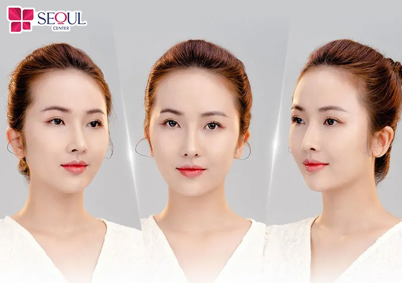 Thu gọn cánh mũi giúp khuôn mặt trông thanh thoát hơn