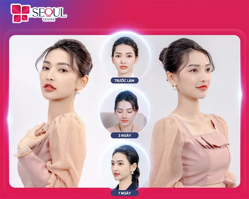 Khách hàng trở nên tự tin hơn với dáng mũi thon gọn