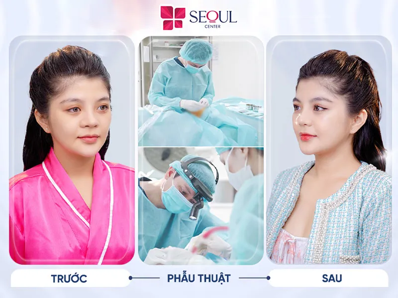 Thu gọn cánh mũi giúp khách hàng xóa bỏ tự ti về dáng mũi xấu