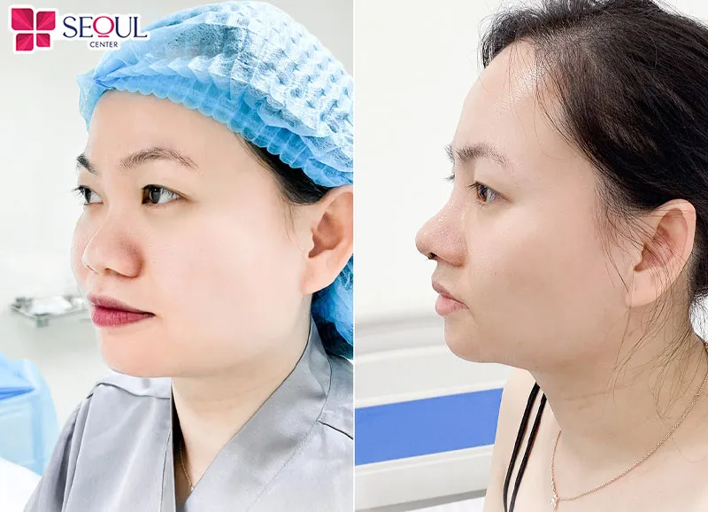 Cánh mũi to, dày và tẹt được cải thiện nhờ phương pháp Thu gọn cánh mũi tại Seoul Center