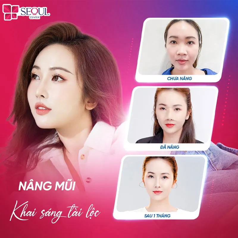 Đầu mũi to, cánh mũi xòe được khắc phục hoàn hảo nhờ Thu gọn cánh mũi