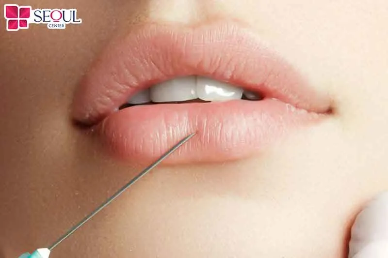 Sở hữu dáng môi tiêm filler đẹp thường là mong muốn của nhiều cô nàng