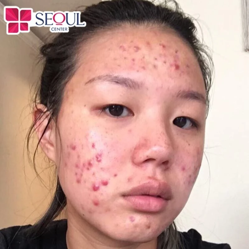 Da các em ở lứa tuổi học sinh 12-15 tuổi thường gặp tình trạng xỉn màu, da không đều màu, nổi mụn, thâm đen