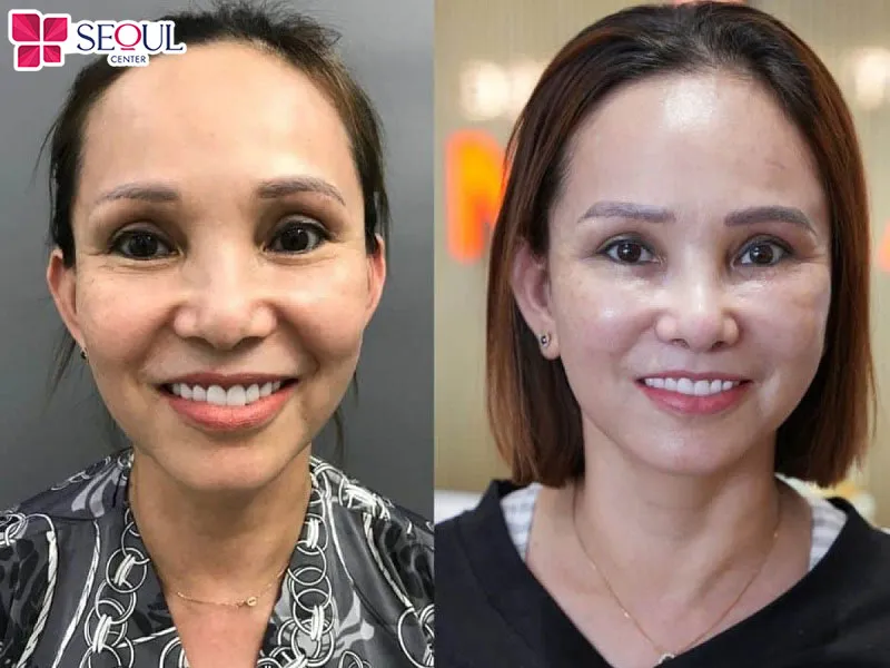 Cấy mỡ má sẽ giúp gương mặt trẻ trung hơn rất nhiều so với tuổi