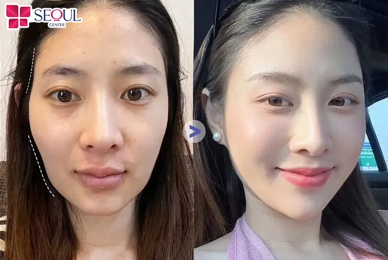 Cấy mỡ má không chỉ làm gương mặt hài hòa, xinh xắn hơn mà còn giúp da căng mịn, tươi trẻ hơn